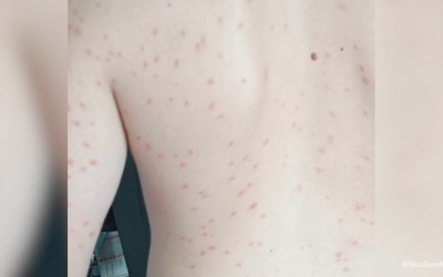 Красными волдырями и сыпью покрываются те, кто недавно купался на озере «Дикое»