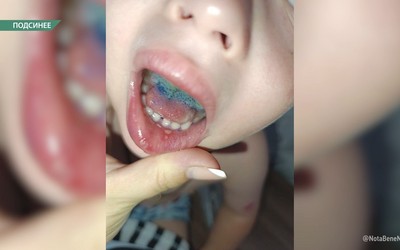 Дети в Подсинском саду массово жалуются на язвы во рту