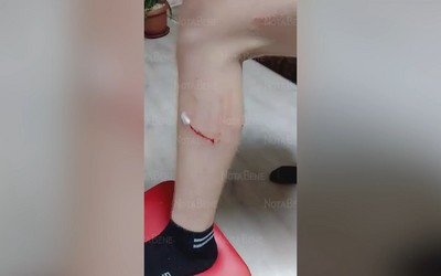 30 тысяч за нападение собаки на ребенка заплатят власти