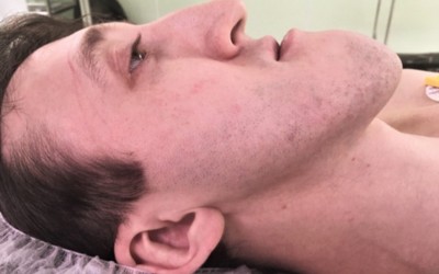 Пациента с аномально большой челюстью прооперировали в Красноярске