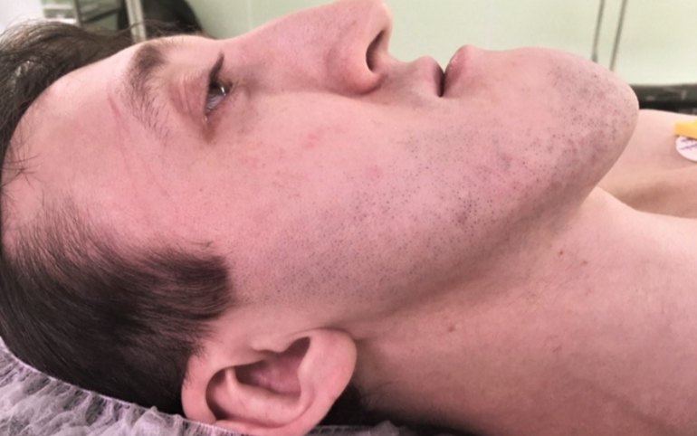 Пациента с аномально большой челюстью прооперировали в Красноярске