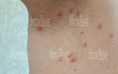 Отдыхающие покрылись сыпью после купания в озере Дикое