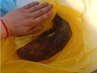 Девушка из Бурятии съела 2 килограмма волос